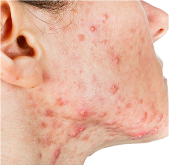 Acne